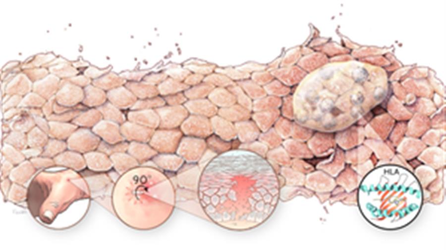Decayed Skin Australian-German research finds world-first cure for deadly skin disease