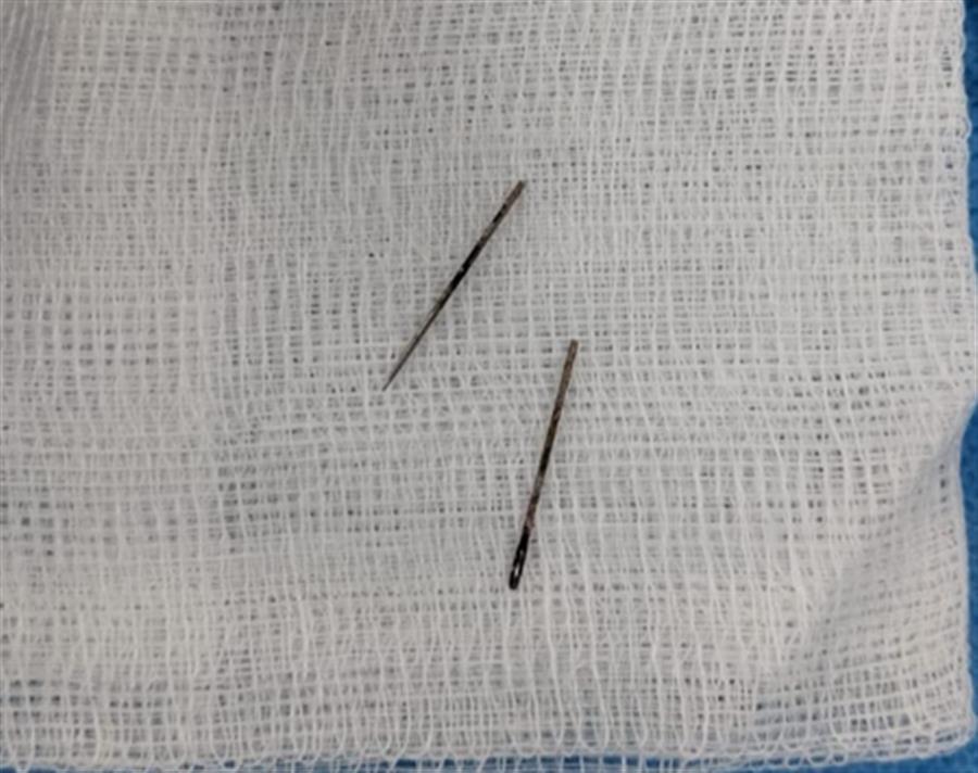 Gujarat: 12-year-old swallows metal pin; AIIMS Rajkot doctors remove it without surgery