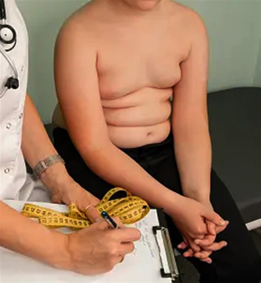 Health experts express concern on rising tide of obesity among Indian kids